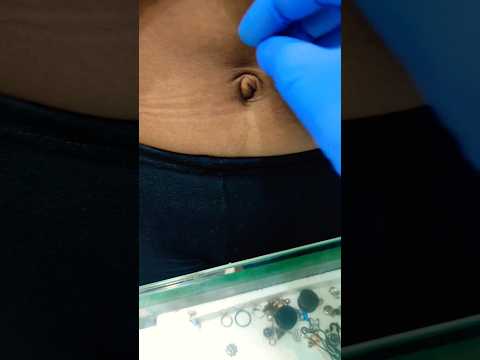 #how repaired navel bump
